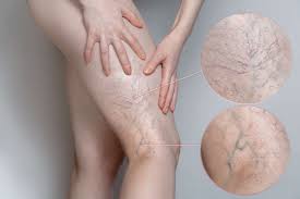 SPIDER and VARICOSE VEINS REMOVAL